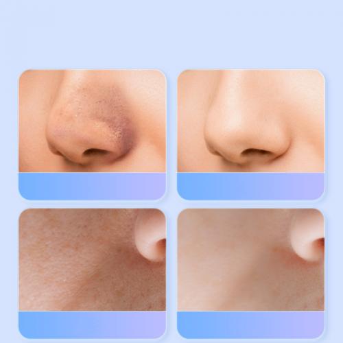 Ультразвуковий скрабер для очищення обличчя Skin Tech Scrubber 3305 Білий (3305O) Ультразвуковий скрабер для очищення обличчя Skin Tech Scrubber 3305 Білий (3305O)